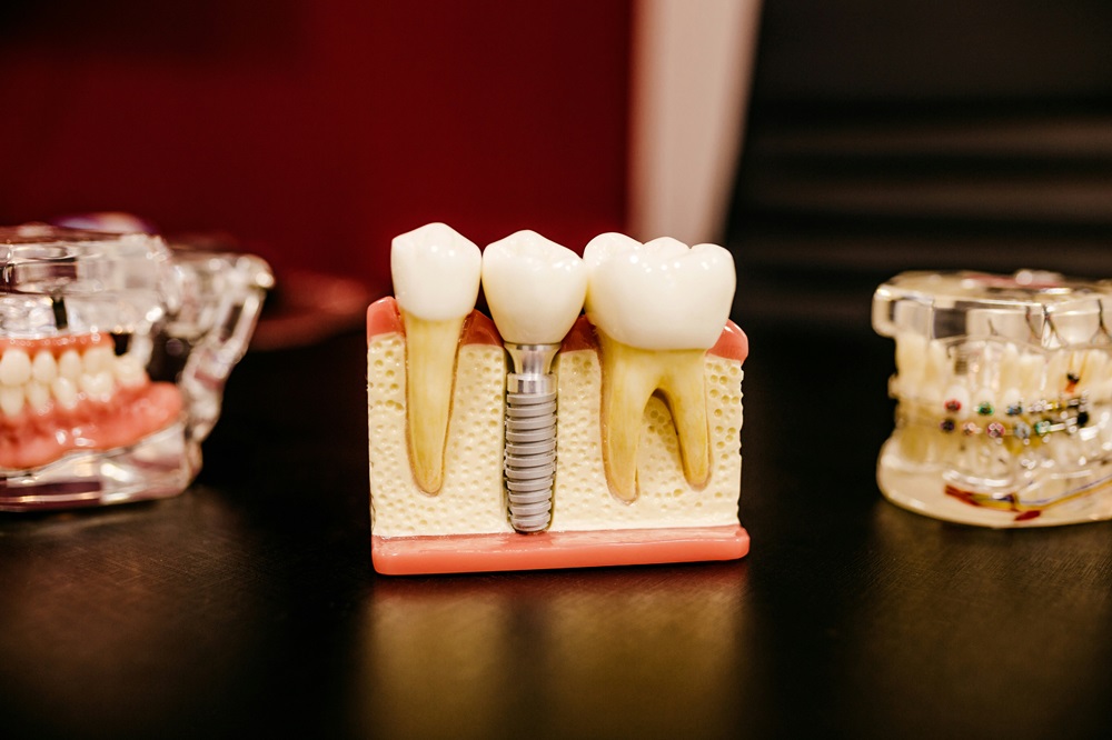 Dental Implants In Regina